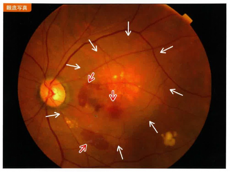 糖尿病網膜症眼底写真