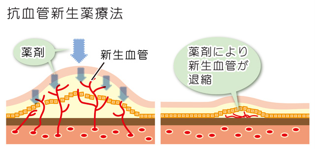 加齢黄斑（抗血管新生薬療法）