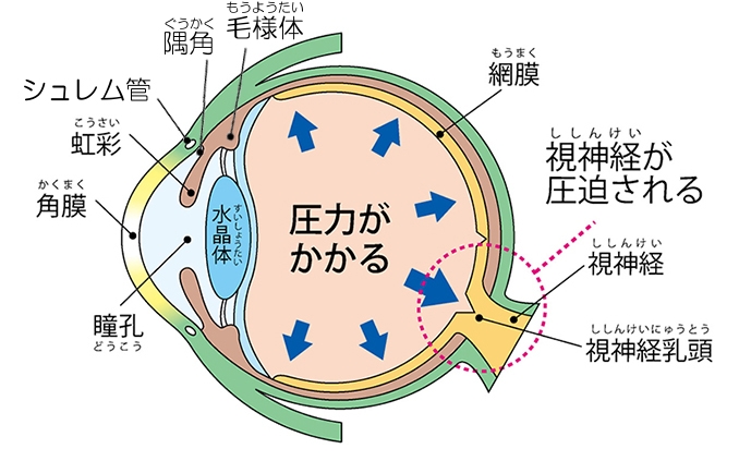 高い 眼 原因 圧